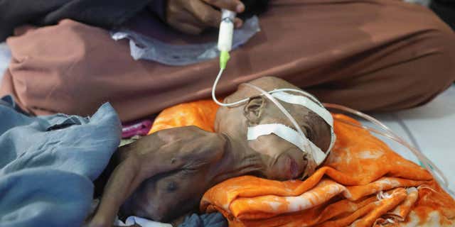 A Somalian woman feeds her starving child through a nasogastric tube in Mogadishu, Somalia, on Sept. 24, 2022.