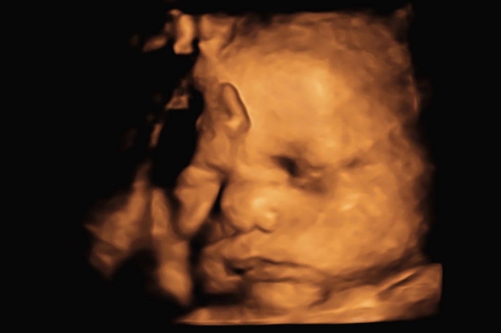 Three- and four-dimensional ultrasounds entered commercial use in the 1990s; three decades later, their increased popularity coincides with the scaling-back of abortion rights across the nation.