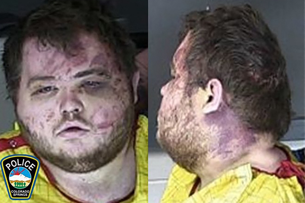 Anderson Lee Aldrich's mug shot shows bruises and other injuries he sustained after patrons inside Club Q jumped the 22-year old and took away his weapons.