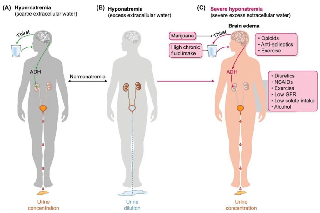 Water balance homeostasis and Bruce Lee's risk factors for hyponatraemia.