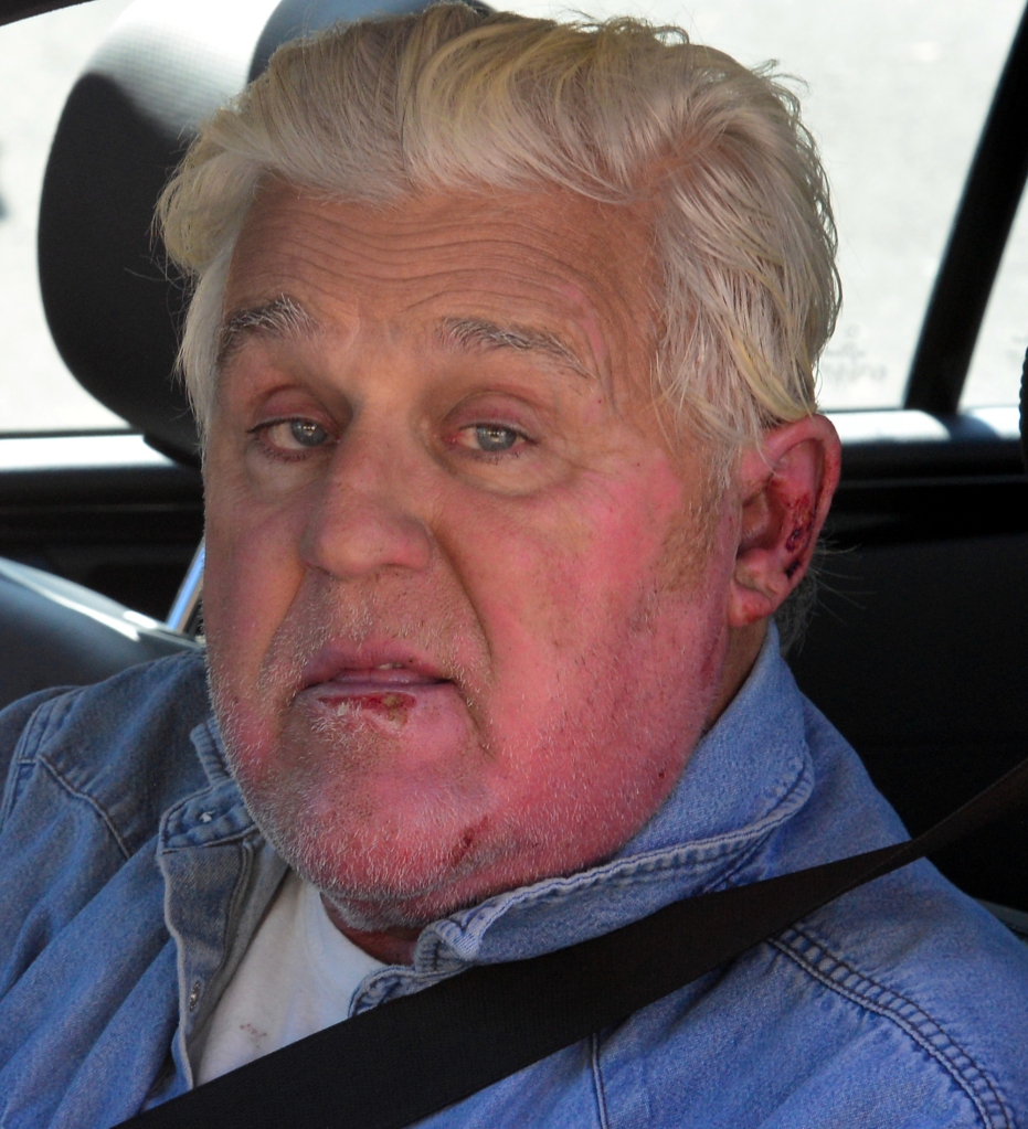 Jay Leno seems to be on the mend with obvious burn signs as is spotted arriving at his car garage in Burbank, Ca.
