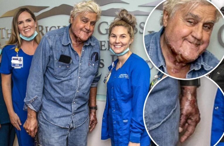 Jay Leno’s face revealed for first time since gasoline fire