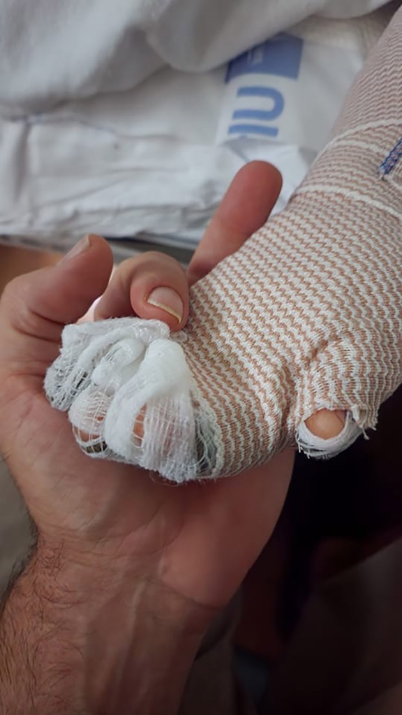 Son Jeffrey's bandaged hand