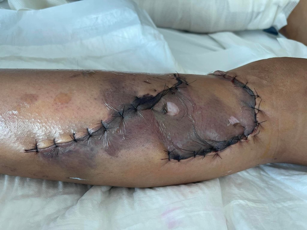 Amor Armitage's leg wound after surgery