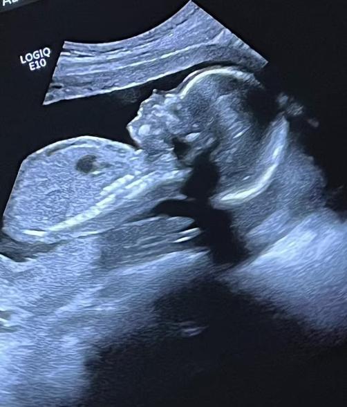 Keke Palmer ultrasound