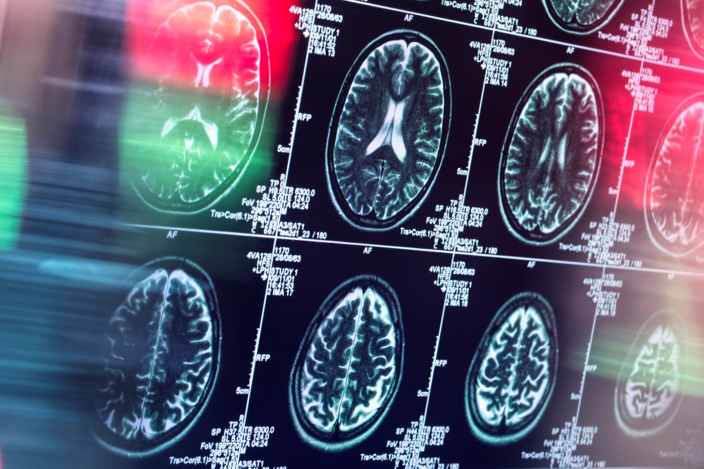 Human brain scan in neurology clinic