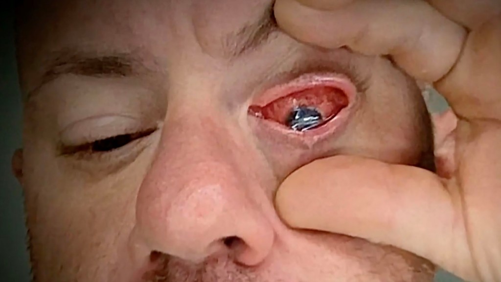 Naples Fire Capt. Adam Di Sarro shows his infected eye