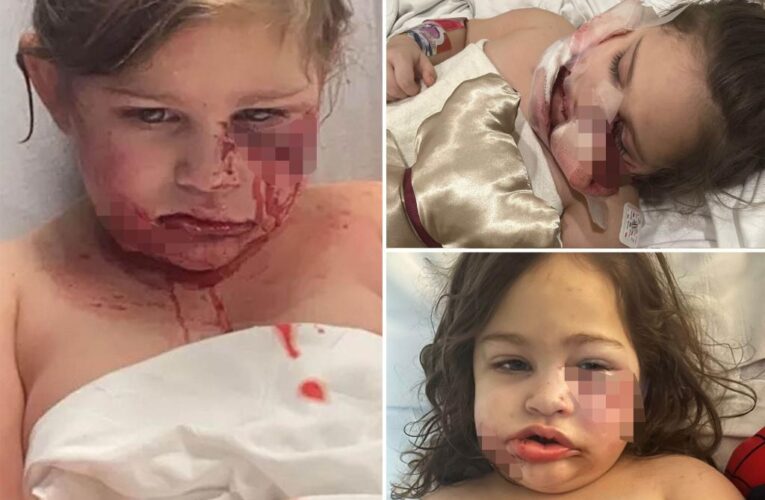 3-year-old Louisiana girl can no longer smile after dog bite