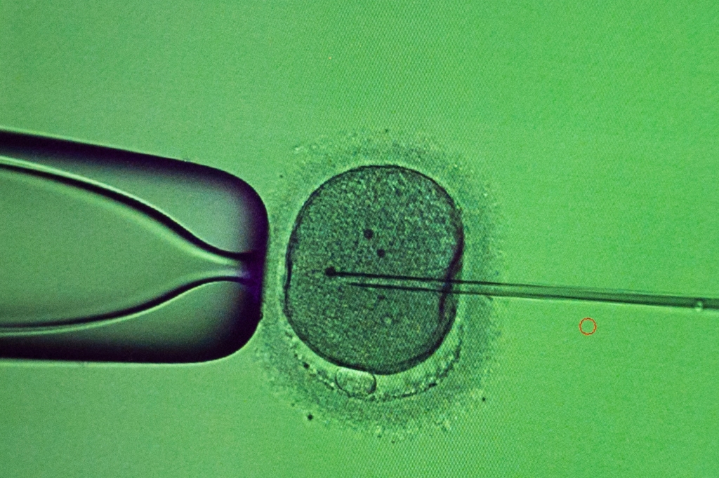 A doctor conducts the procedure of intracytoplasmic sperm injection (ICSI) at the laboratory of the IVMED fertility clinic in Kyiv, Ukraine,