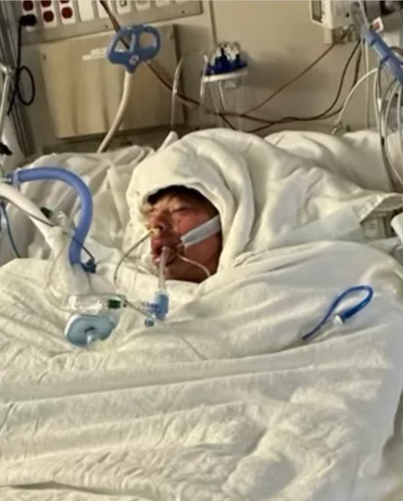 Mason was rushed to the UNC Burn Center with burns covering 76% of his body, his mother said.