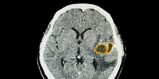 Brain abscess