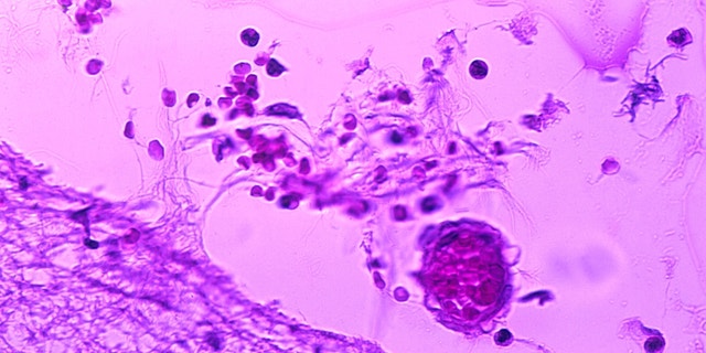 Mild meningitis with hemorrhage due to Bacillus anthracis. Photomicrograph of mild meningitis along with hemorrhage, and the presence of Bacillus anthracis in a case of fatal human anthrax.