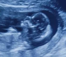 Kaitlyn Anderson's ultrasound.
