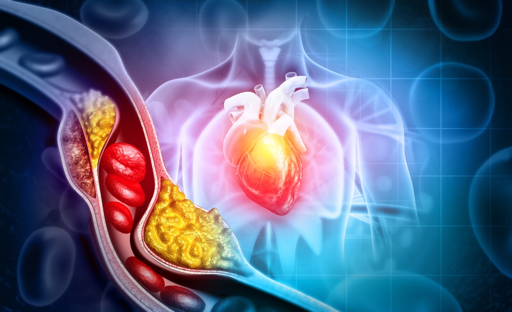 Around half of Americans between the ages of 45 and 84 have atherosclerosis, but don't know it. 