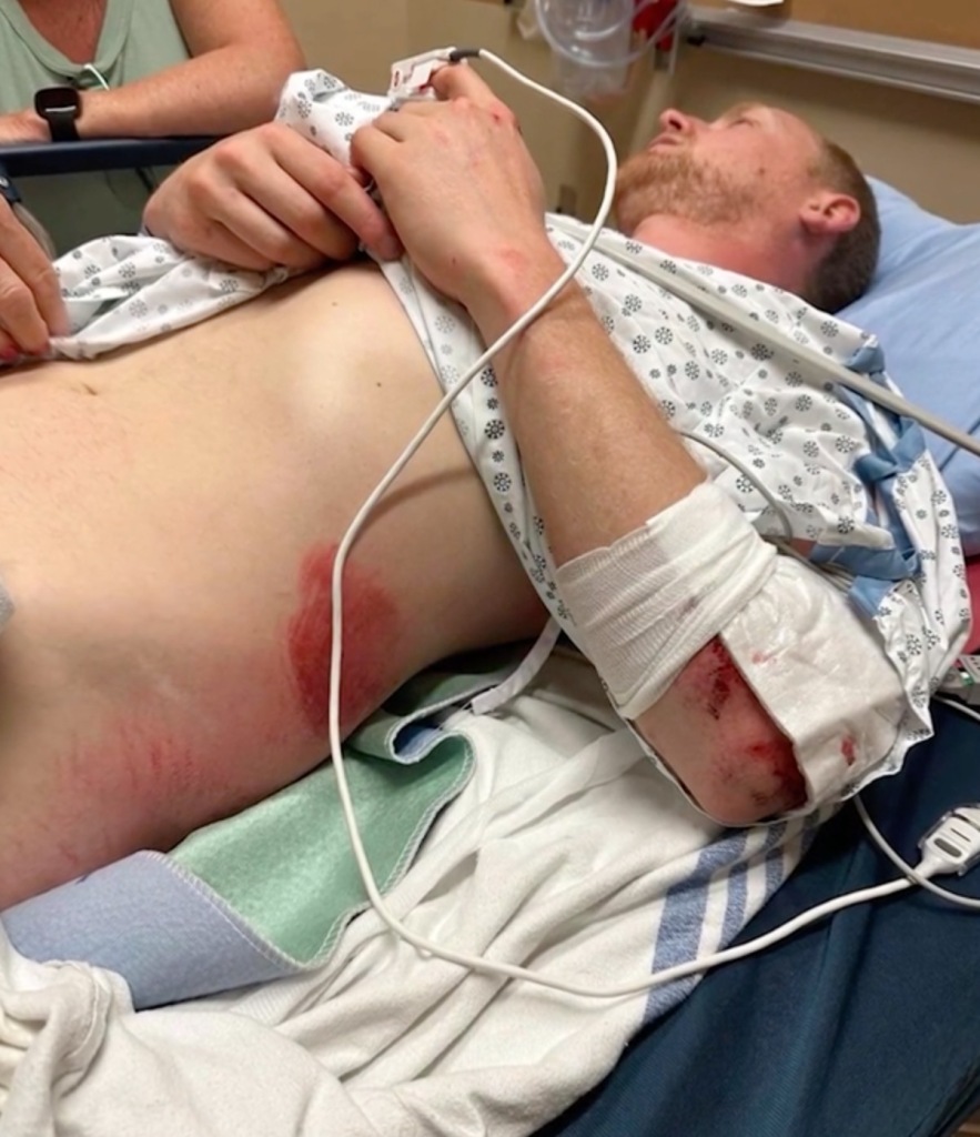 Kevin Milner is pictured lying down in the hospital, wounds to his side and armed are shown