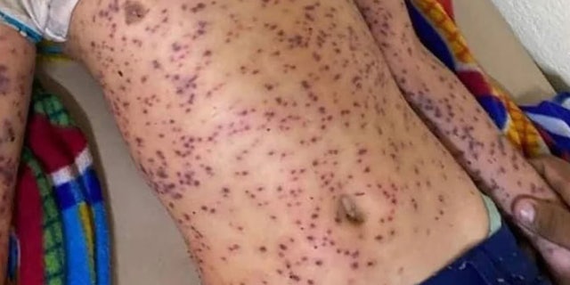 Bee stings on victim's torso