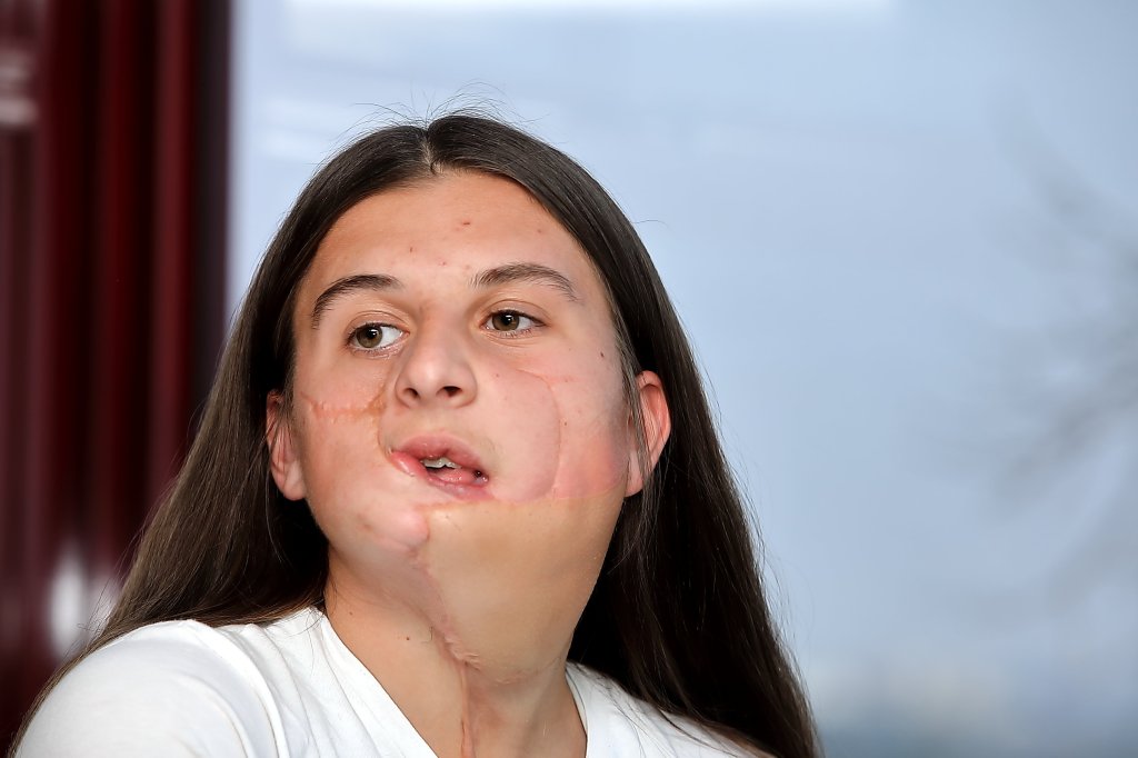 Woman with facial disfiguration and long dark hair wearing white shirt.