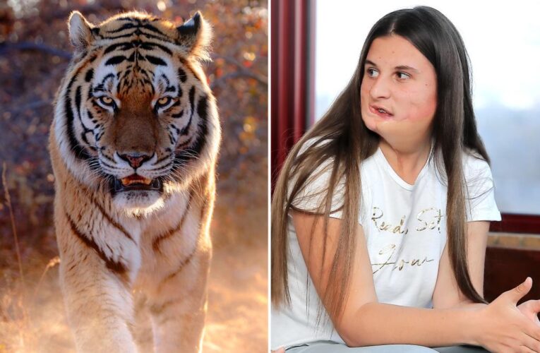 My face was ripped off by a tiger when I was a baby — but I love myself