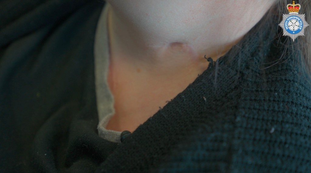 Victim's throat scar