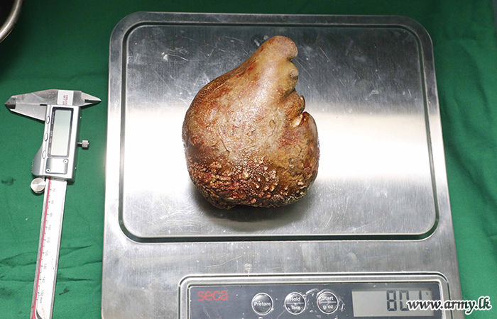 The large kidney stone on a scale.