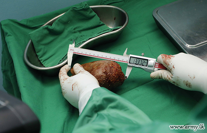 The kidney stone being measured by a doctor.