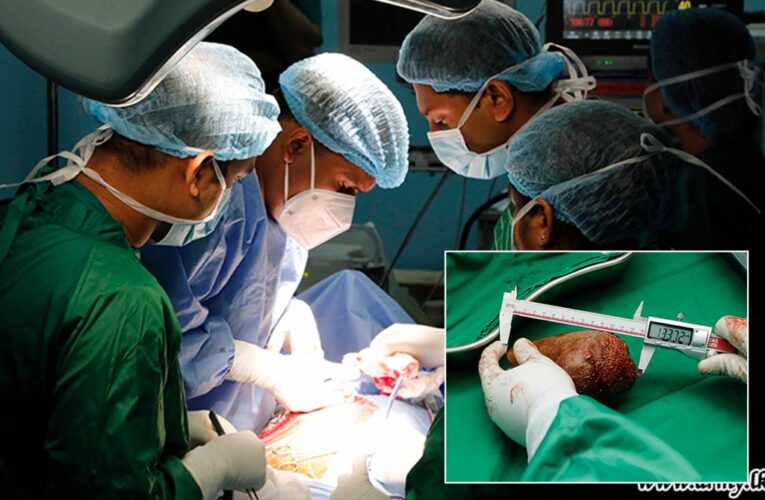 Doctors in Sri Lanka remove ‘world’s biggest kidney stone’