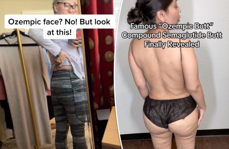 ‘Ozempic butt’ is latest bizarre side effect of trendy weight-loss drug