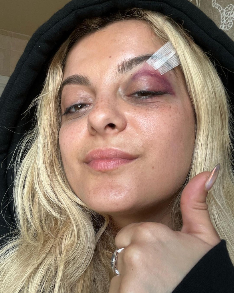 Bebe Rexha shows off black eye, stitches after fan chucks phone at her mid-concert.