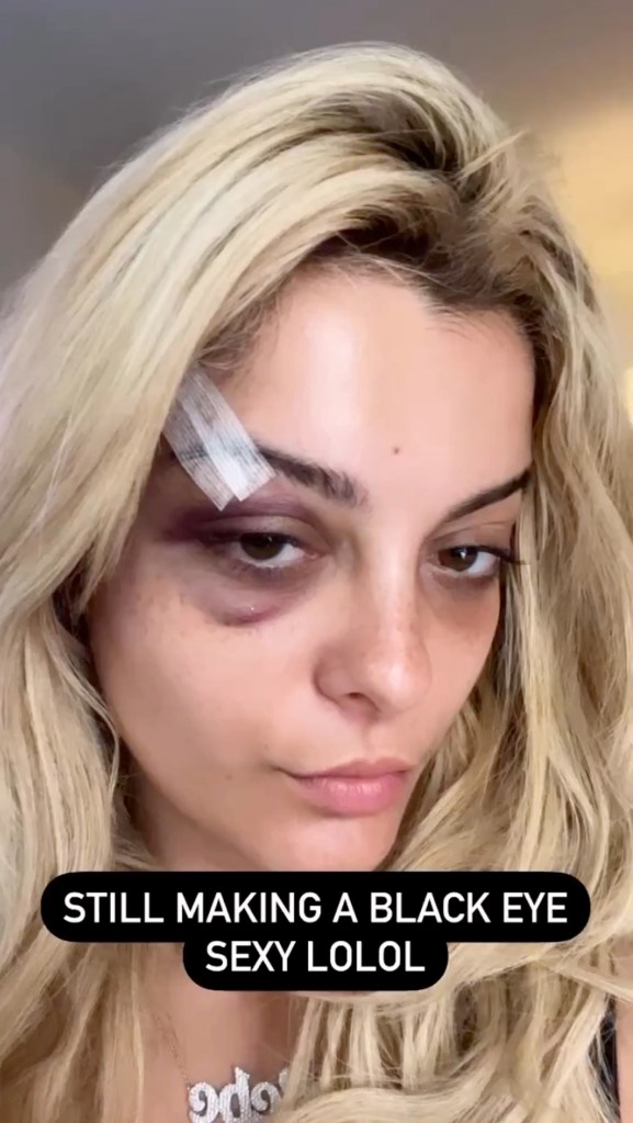 Bebe Rexha documented her injuries in an Instagram post.