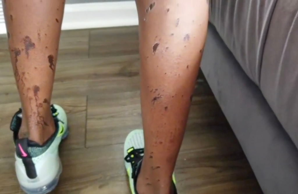 Deaira Summers' burns on her legs. 