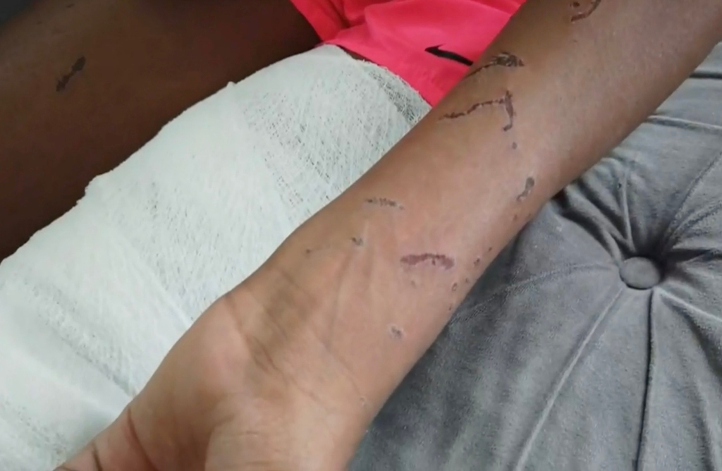 Deaira Summers' burn on her arm.