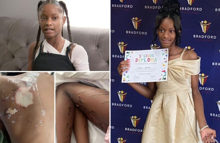 Detroit girl, 12, arrested for grisly acid attack on another kid