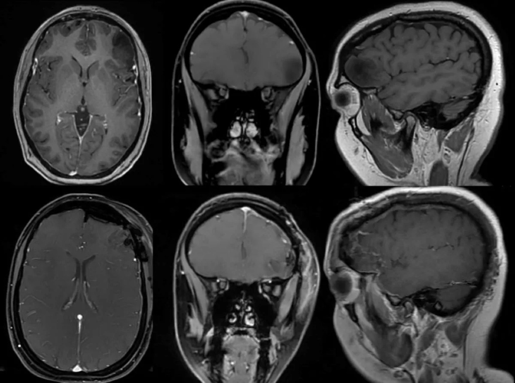 Vied's brain MRI scan. 