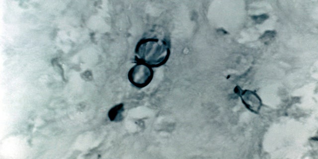 Blastomyces Dermatitidis