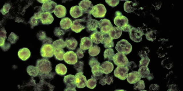 Photomicrograph of amebic meningoencephalitis