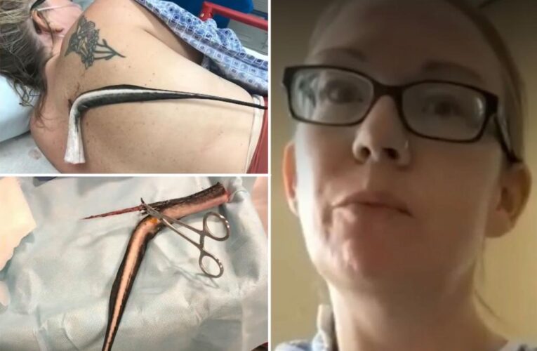 Florida woman impaled by ‘super painful’ venomous stingray
