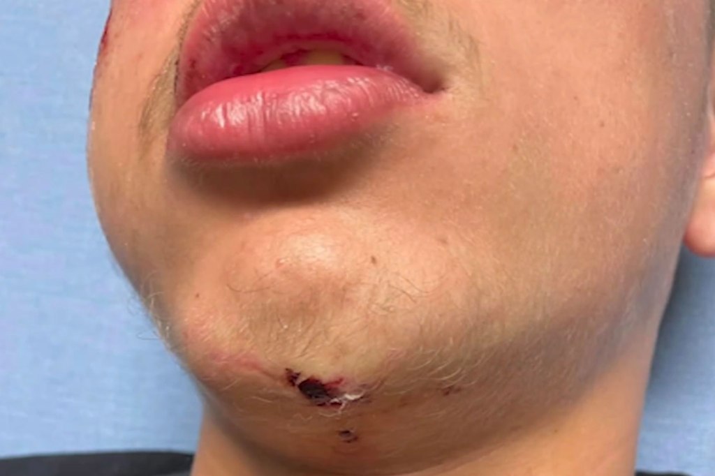 cut chin of teenager