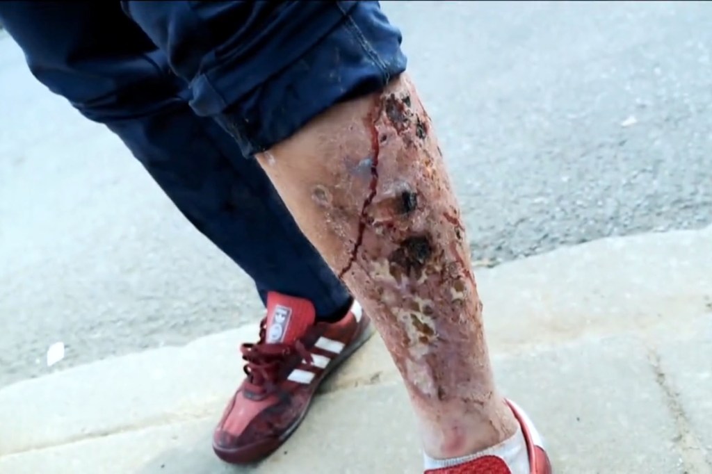 Horrific wounds caused by "tranq" seen on a person's leg