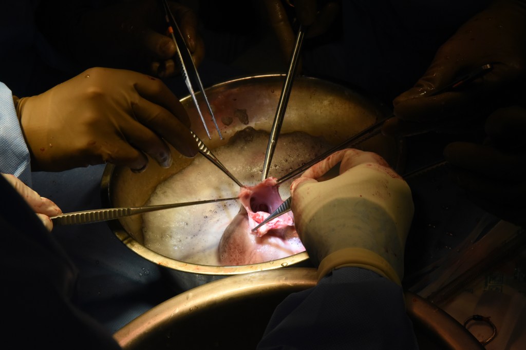 Surgeons perform the pig heart transplant at the University of Maryland School of Medicine hospital in Baltimore, Maryland.