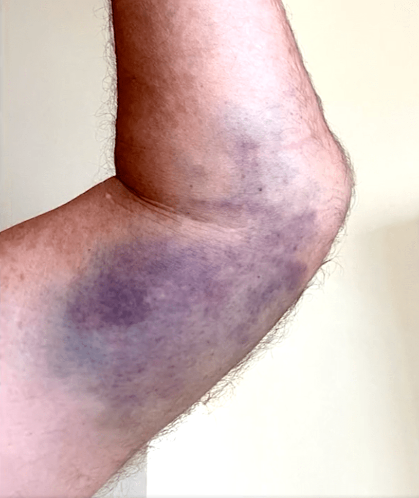 The shaken-up reporter said he was hospitalized and shared a photo of his left elbow, sporting a rather large bruise alongside a diagram of a radial head fracture, an injury he suffered and confirmed to SFist.