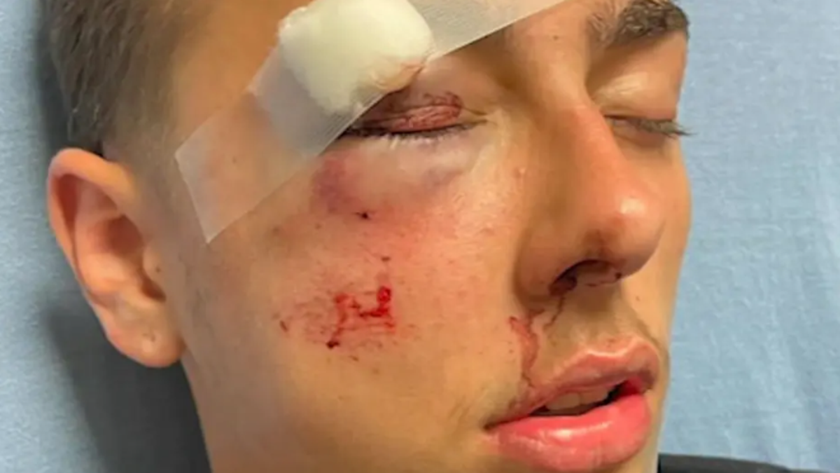 Injuries suffered by 15-year-old during state trooper's alleged assault