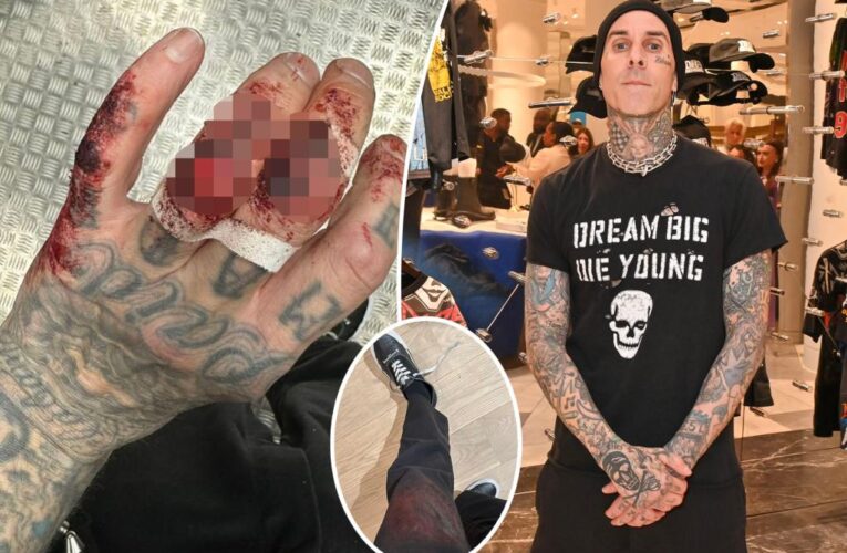 Travis Barker reveals bloody hand injury after Blink-182 show in England