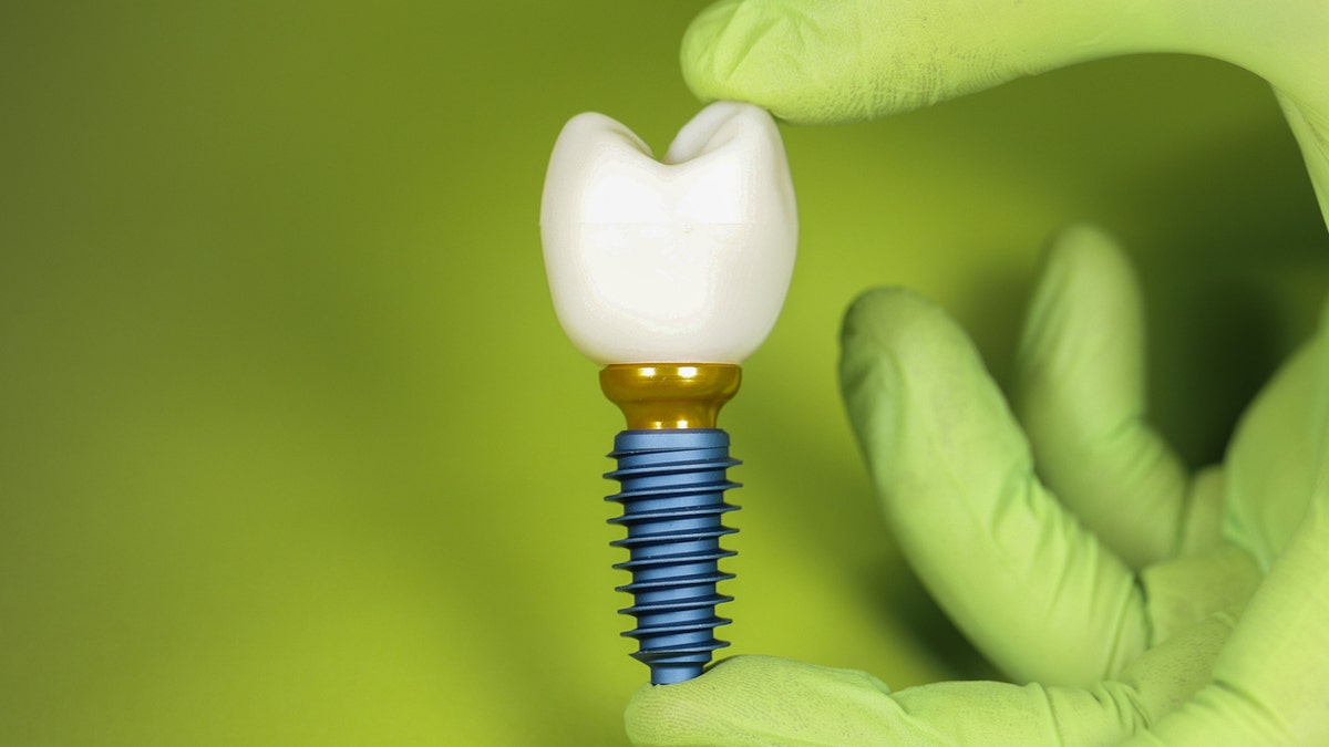 Dental implants