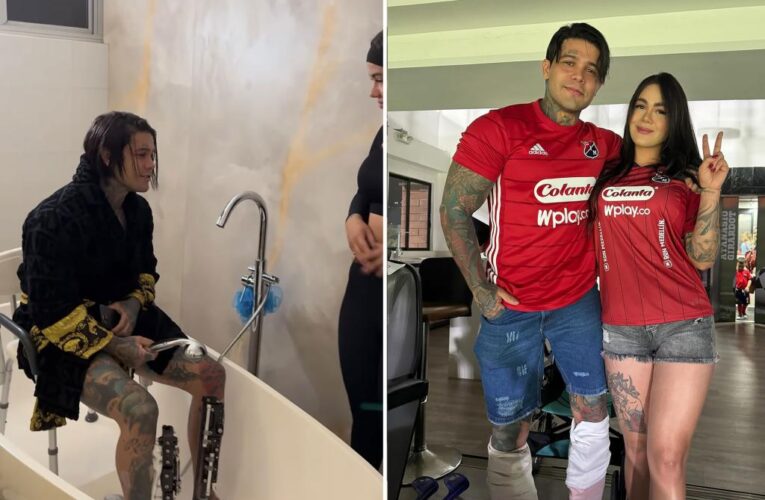 Yeferson Cossio spends $175K on leg lengthening surgery