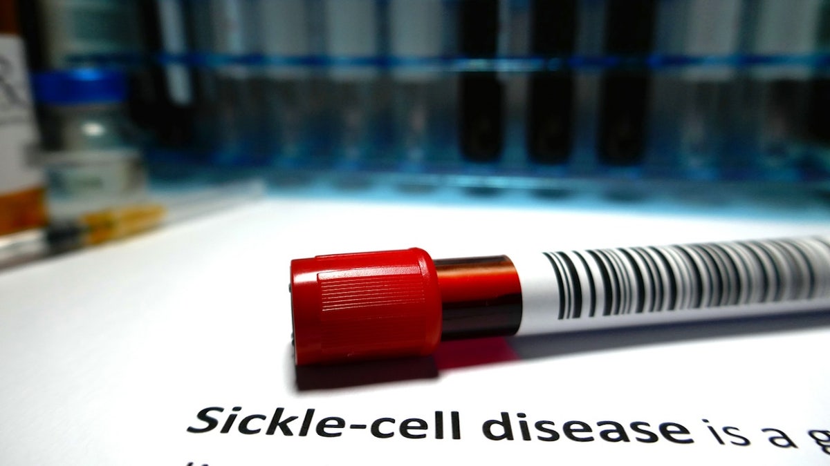 Sickle cell disease