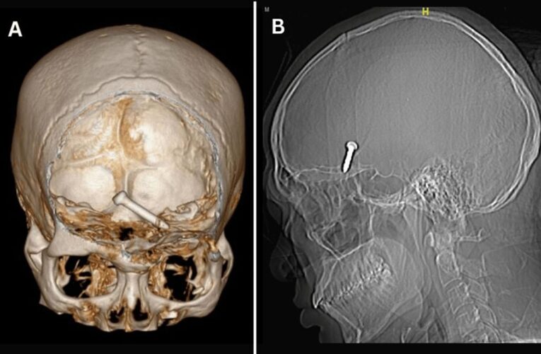 Construction worker shoots nail through eye into brain — and keeps sight