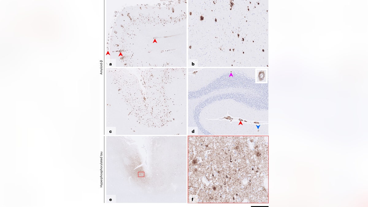 Postmortem brain tissue