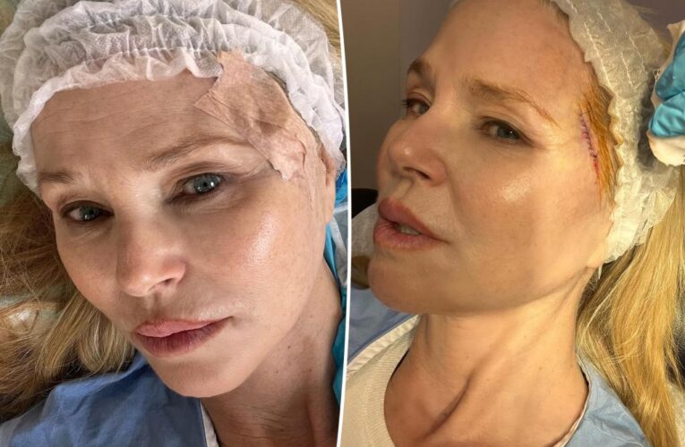 Christie Brinkley reveals skin cancer diagnosis, details graphic treatment